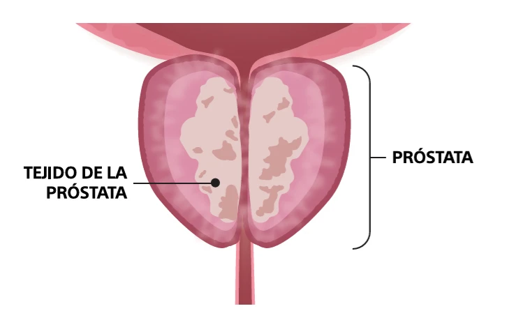 Rezum, antes del tratamiento | Urologista @ Medii