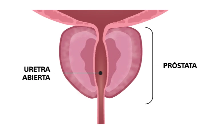 Rezum, después del tratamiento | Urologista @ Medii