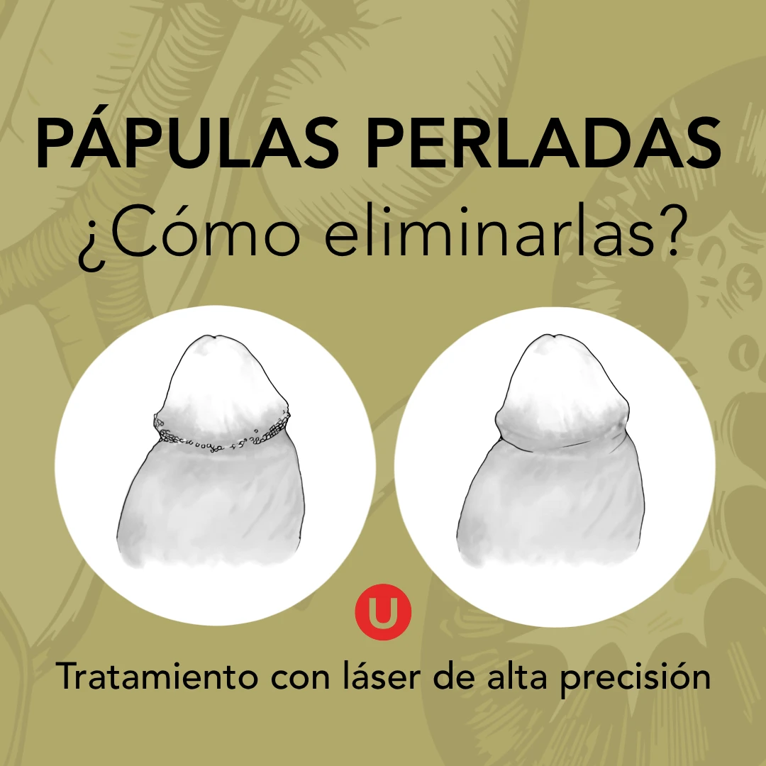 Tratamiento moderno para las pápulas perladas - avances en láser de alta precisión, Urologista @ Medii